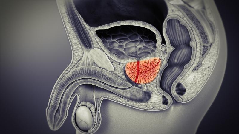 3D Treatment for Prostatitis Review